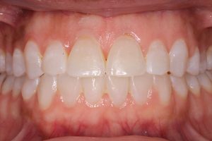 close-up of teeth after treatment