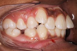 close-up of teeth before treatment