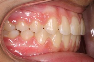 close-up of teeth after treatment